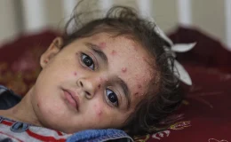 Gazze’de İsrail saldırıları ve ablukası nedeniyle cilt hastalıkları yayılıyor